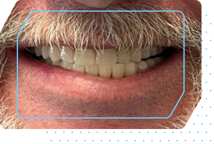 implant-image
