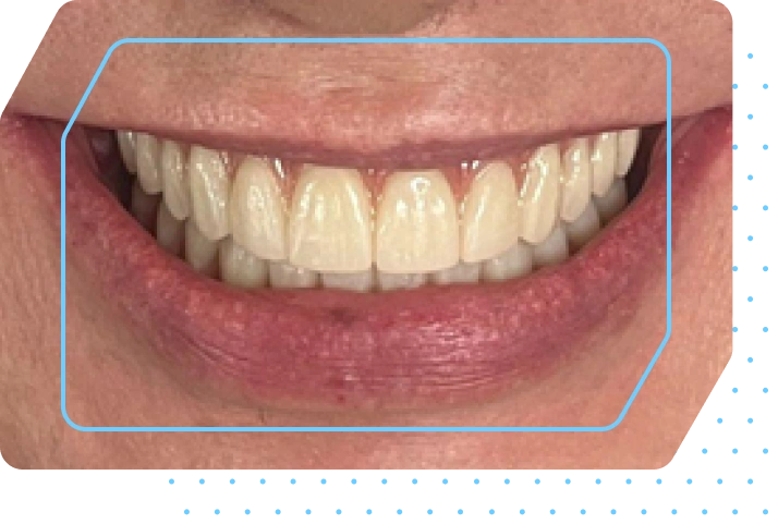 implant-image